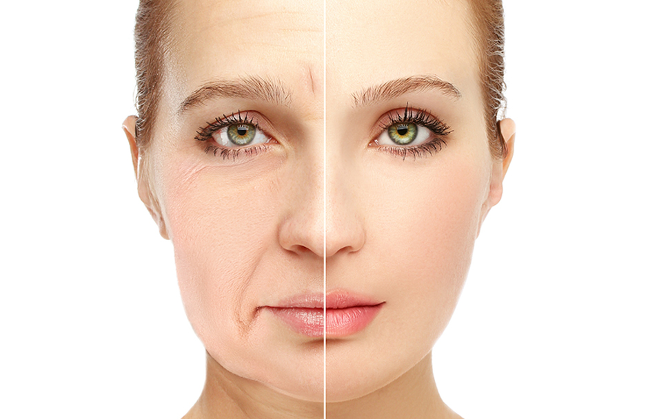 Radio frequency anti face wrinkle before and after