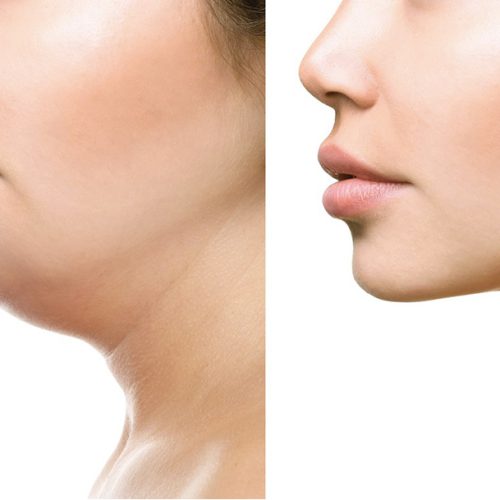 Face Lifting Before and After